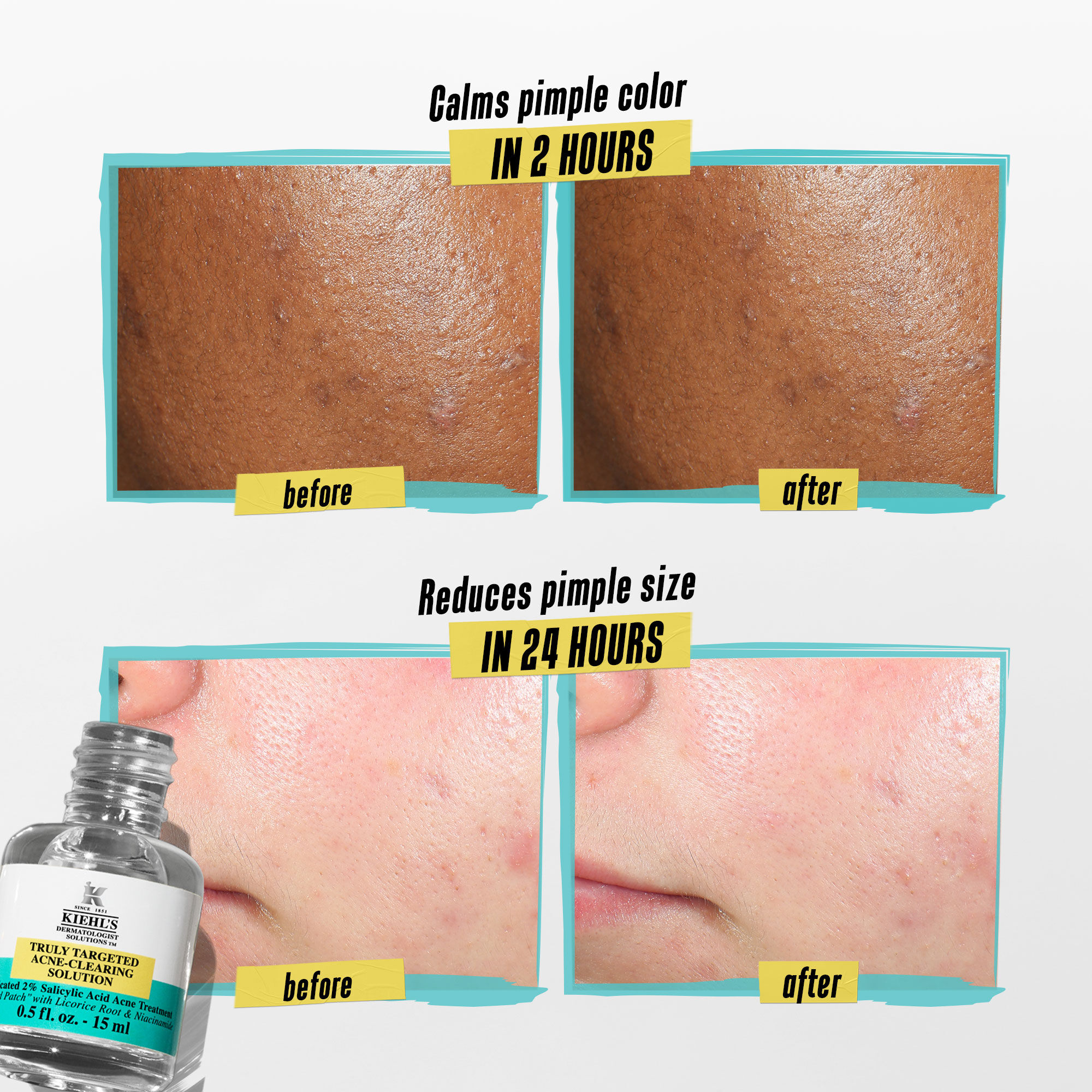 Truly Targeted Blemish-Clearing Solution