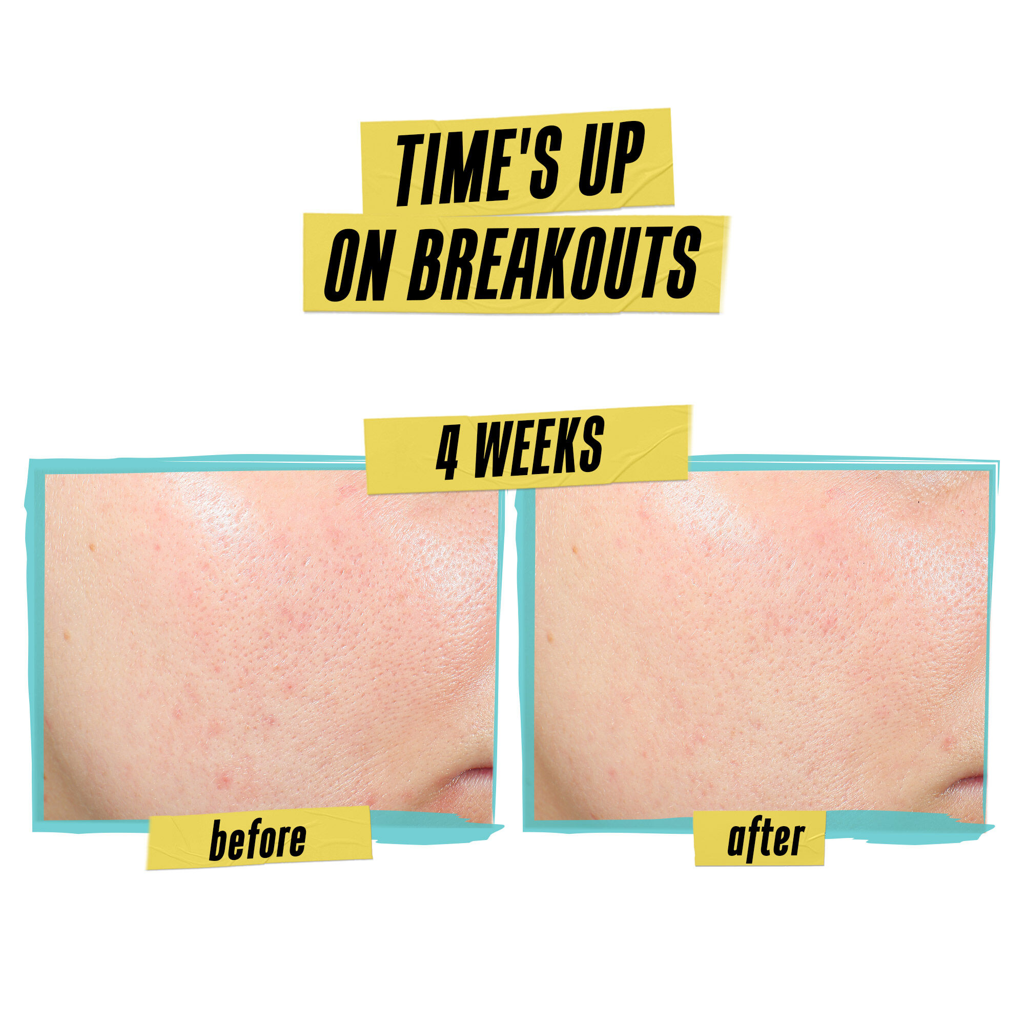 Expertly Clear Blemish-Treating & Preventing Lotion